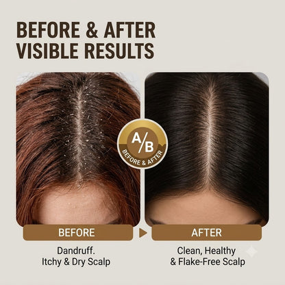 Anti-Dandruff Shampoo Scalp Care Shampoo for Dandruff 200g
